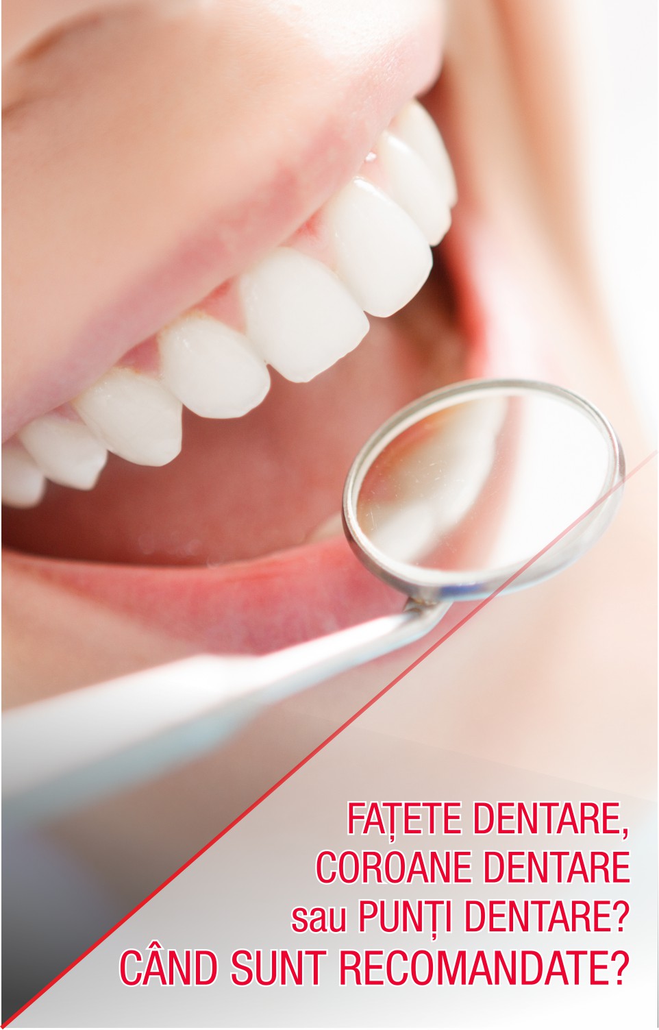 Fațete dentare, coroane dentare sau punți dentare? Când sunt recomandate?